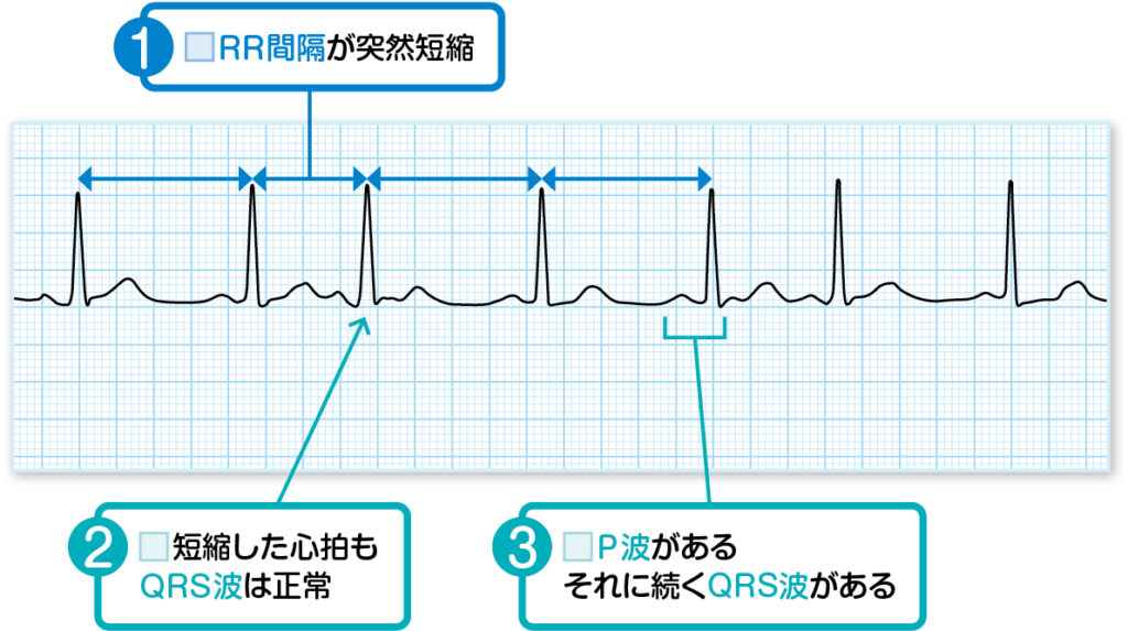 心房期外収縮の読み方