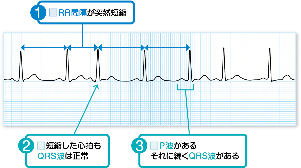 心房期外収縮の読み方