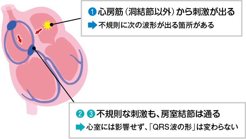 心房期外収縮の読み方２