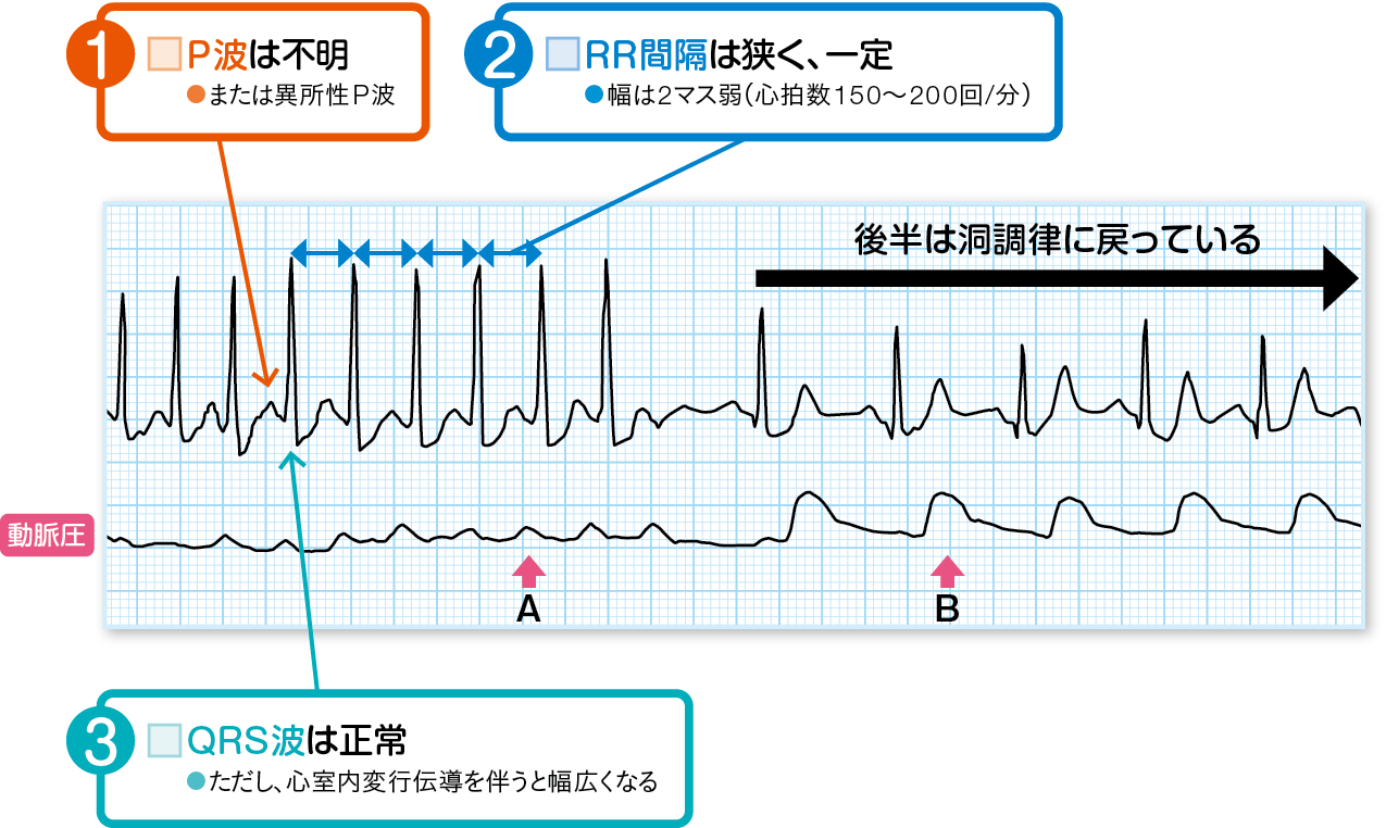 発作性上室頻拍の読み方を説明する心電図