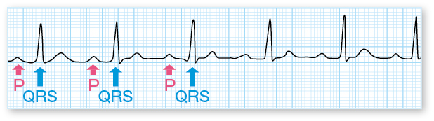 Ⅰ度房室ブロック