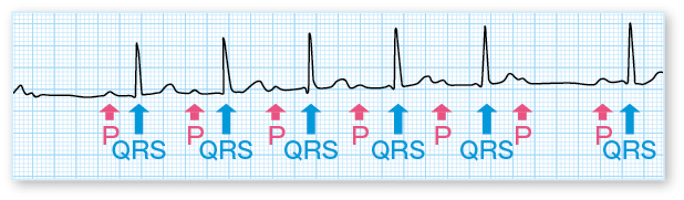 ウェンケバッハ型(モビッツⅠ型)