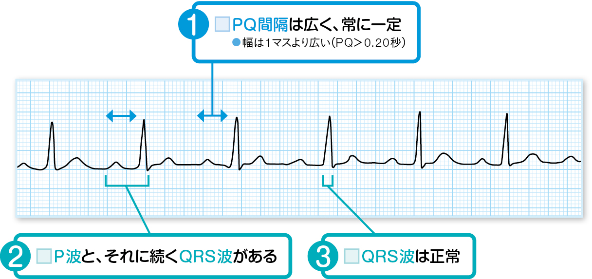 Ⅰ度房室ブロックの読み方