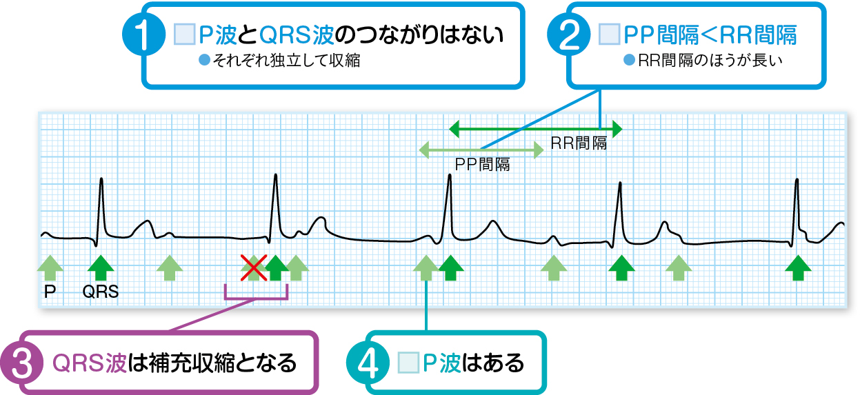 完全房室ブロック（Ⅲ度房室ブロック）の読み方