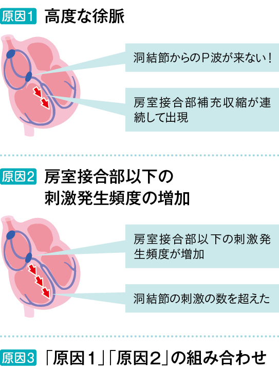 房室解離が起こる原因