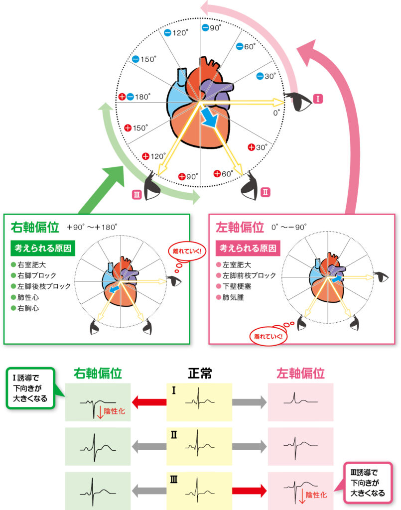 軸偏位の方向と考えられる疾患