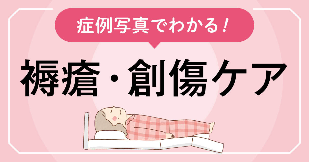 仙骨部の評価スケールd1褥瘡のケア | エキスパートナースweb