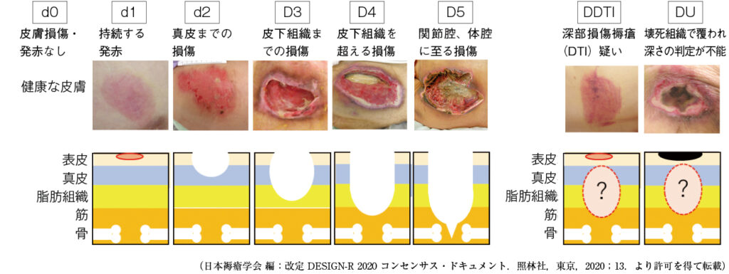 改定 DESIGN-R® 2020の深さの採点の図