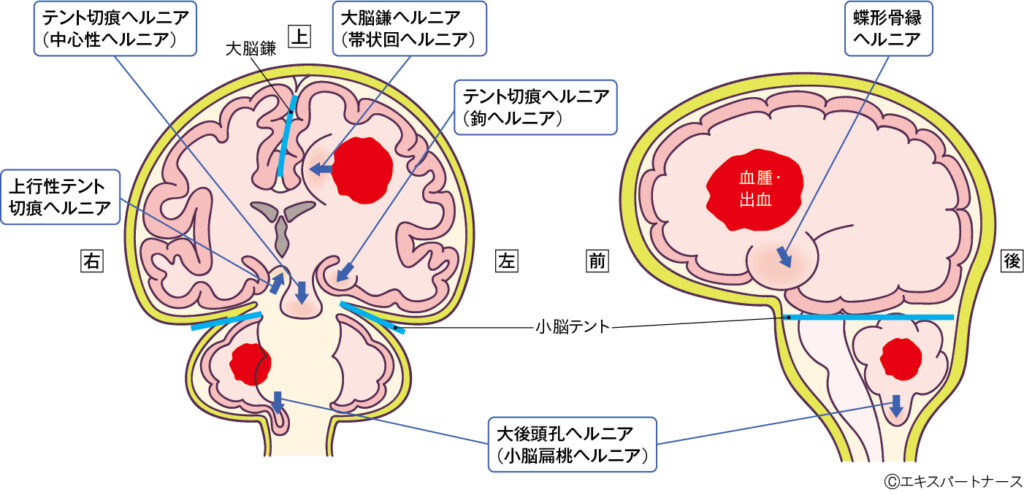 図2 主な脳ヘルニア