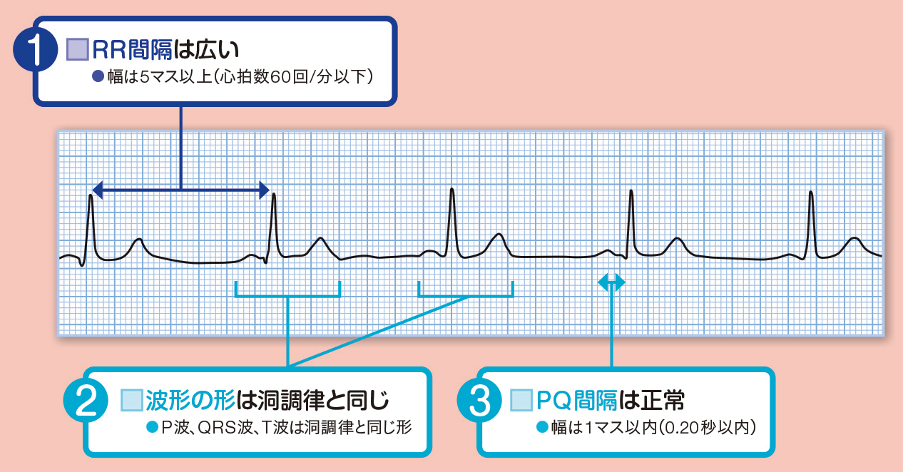 洞徐脈の読み方のポイント