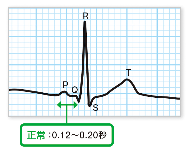 PQ間隔
