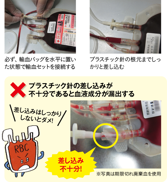 輸液セットをつなぐときのポイント
