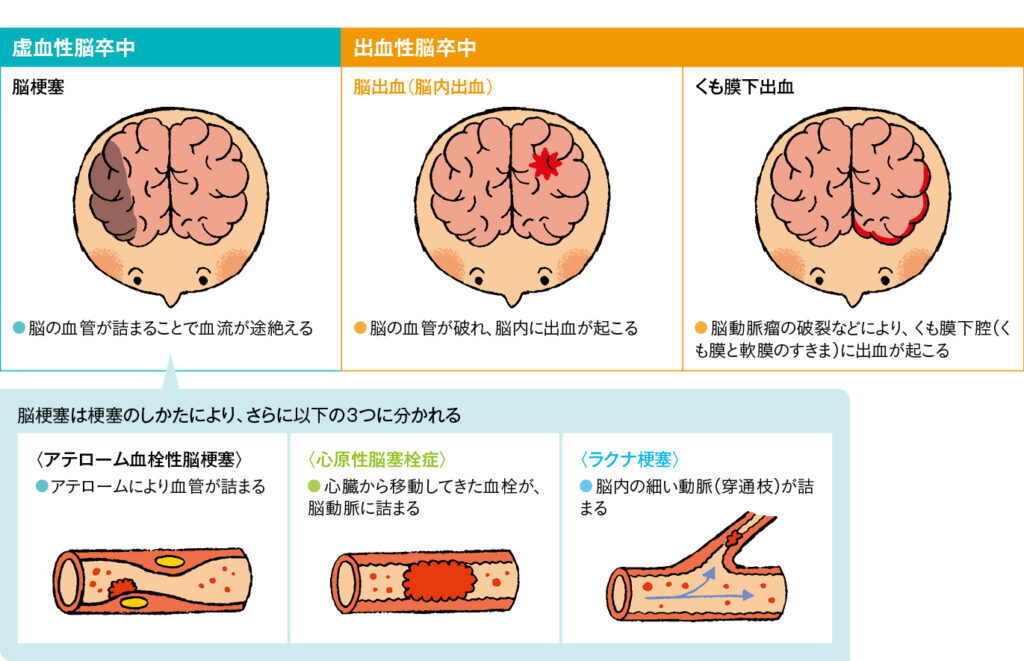 表1　脳卒中の分類