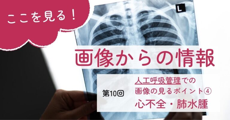 画像からの情報10心不全・肺水腫サムネイル