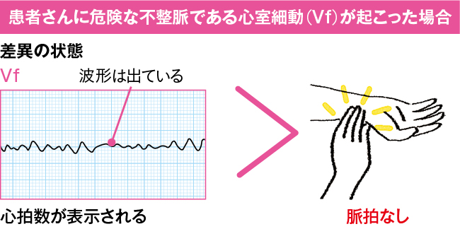 モニター心電図の心拍数と実測の脈拍数が異なる原因は？【バイタル