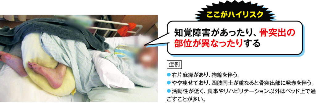 脊髄損傷、半身麻痺の症例写真