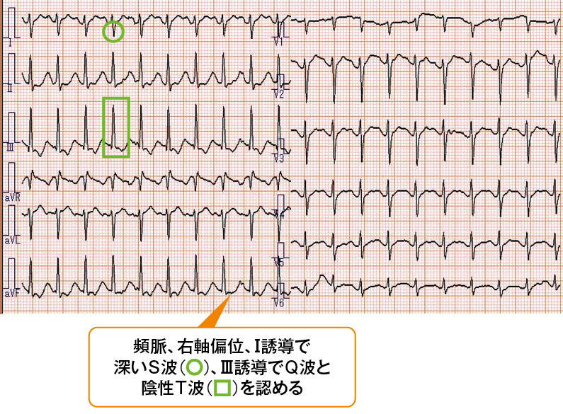 心電図
