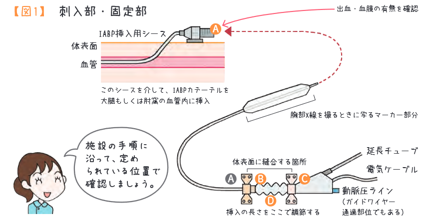 【ICUナースが解説】IABP機器管理とケアの実践ポイント | エキスパートナースweb