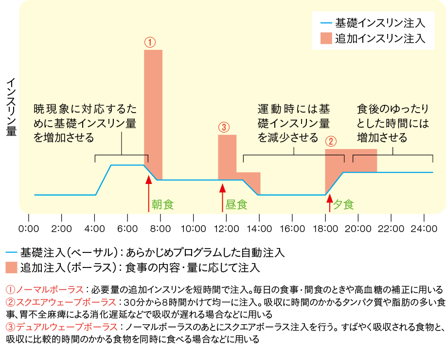 ポンプによるインスリン注入のイメージ
