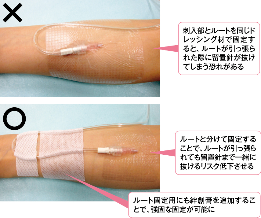 適切な刺入部とルートの固定