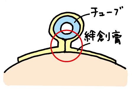 全周包み込み法の説明居ラス後