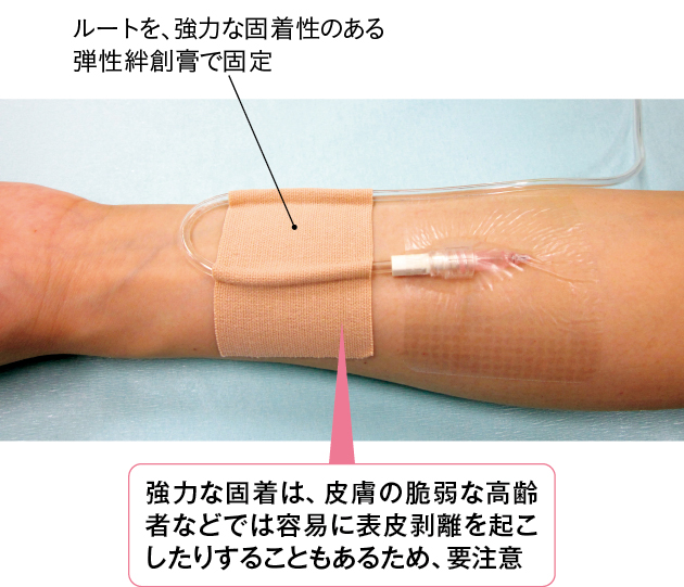 固着性の強い弾性絆創膏を用いた固定の一例