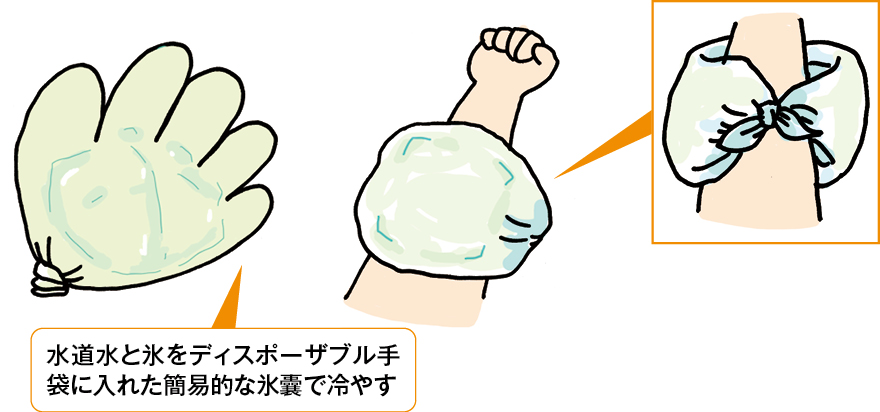簡易的に実施可能な冷罨法の一例のイラスト