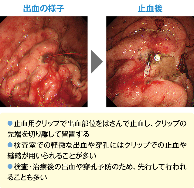 検査室での代表的な止血（クリップ止血法）