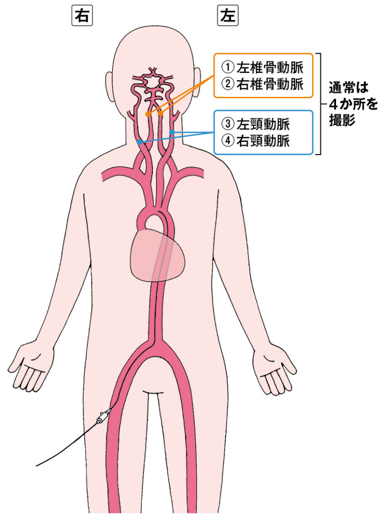 図1　脳アンギオでアプローチする血管