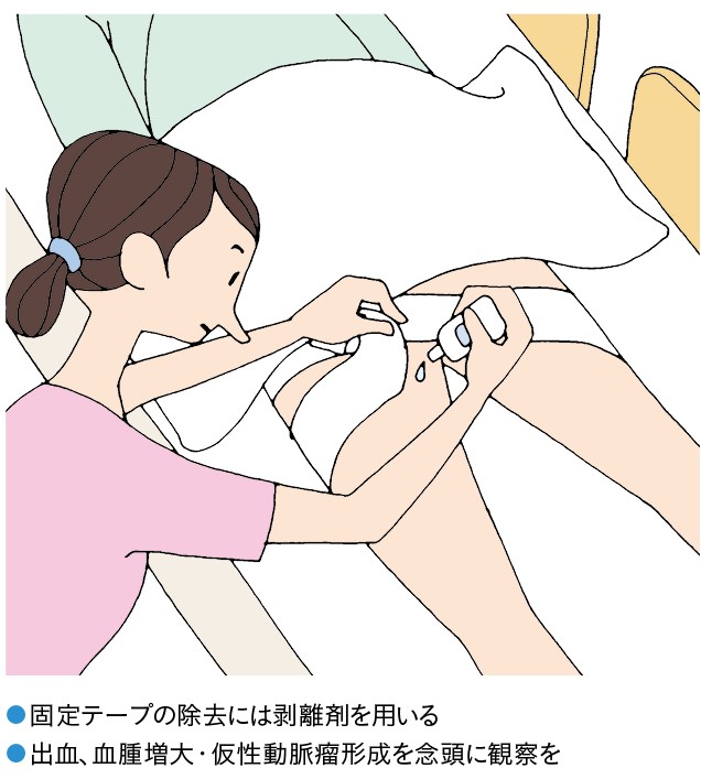 圧迫解除後の穿刺部観察