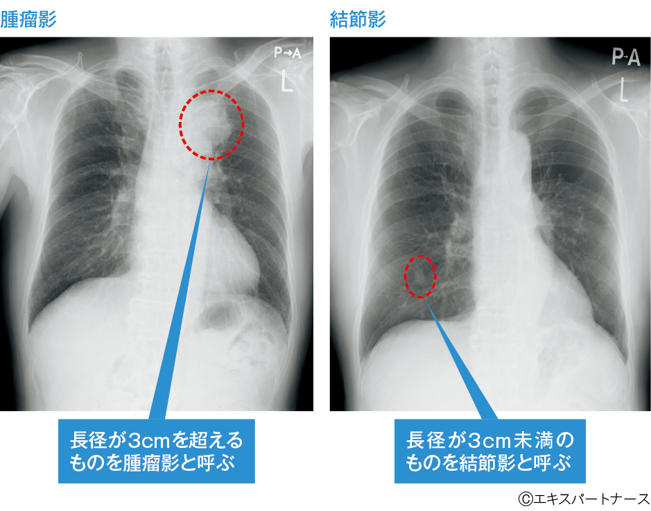 図1　異常のみられる胸部レントゲン画像の例