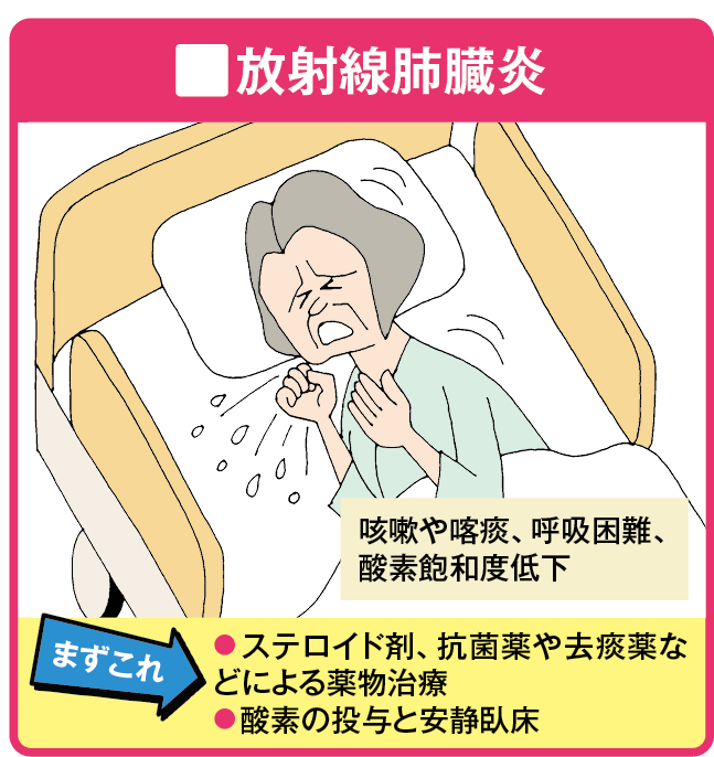 放射線肺臓炎のイラスト