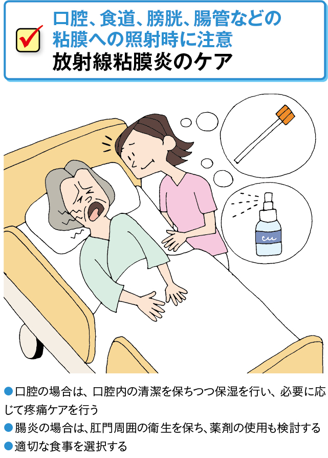 放射線粘膜炎のケア