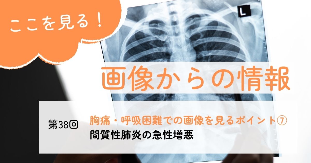 間質性肺炎の急性増悪を画像で見るポイント#38 | エキスパートナースweb