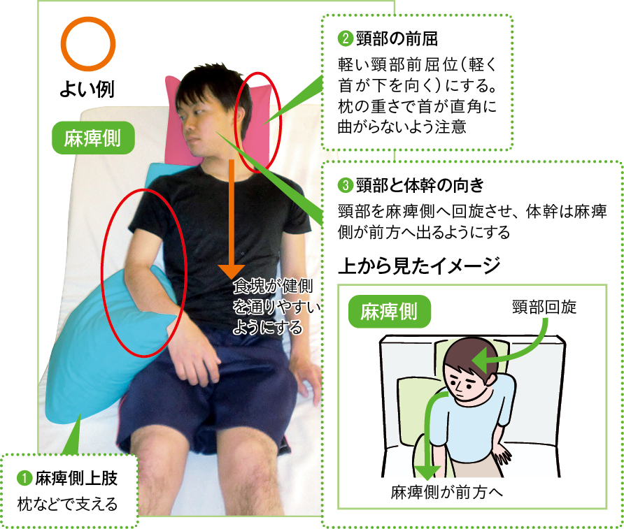 麻痺により嚥下障害(咽頭期)がある場合のポジショニング例
