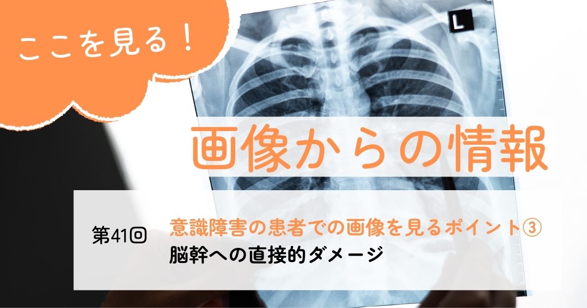 覚醒の障害がある患者で脳幹出血を画像で見るポイント#41