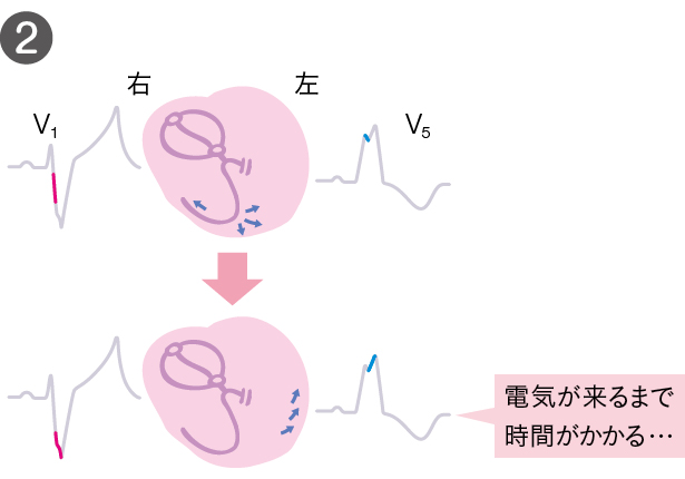 心臓にはこんなことが起きている２