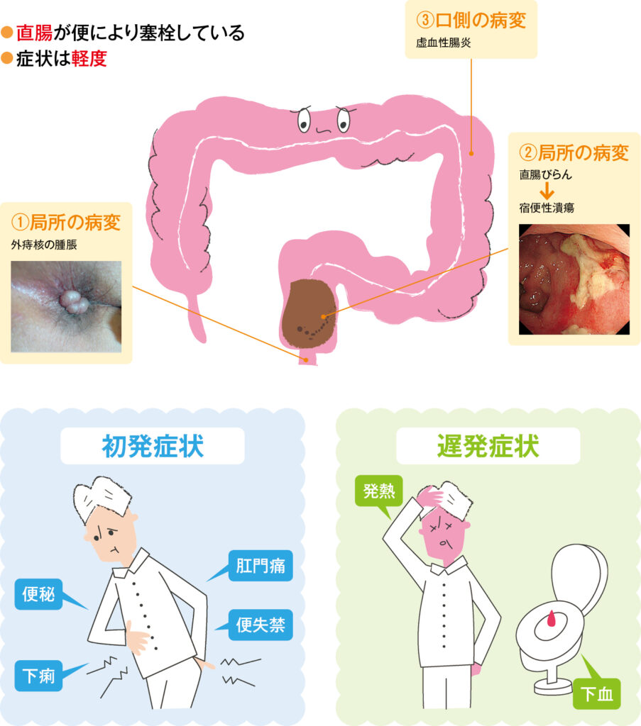 糞便塞栓(直腸)