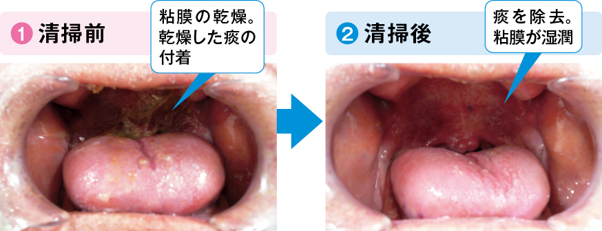 口腔内乾燥