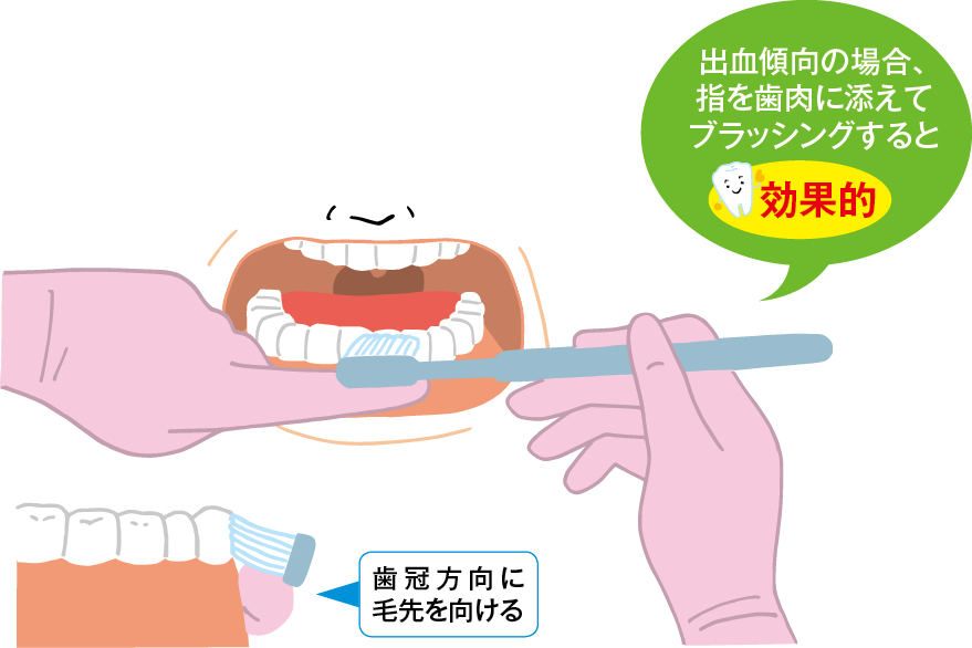 図1　出血しやすい場合のブラッシング