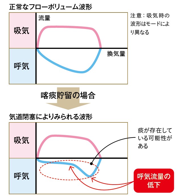 ①フローボリュームのパターンを見る
