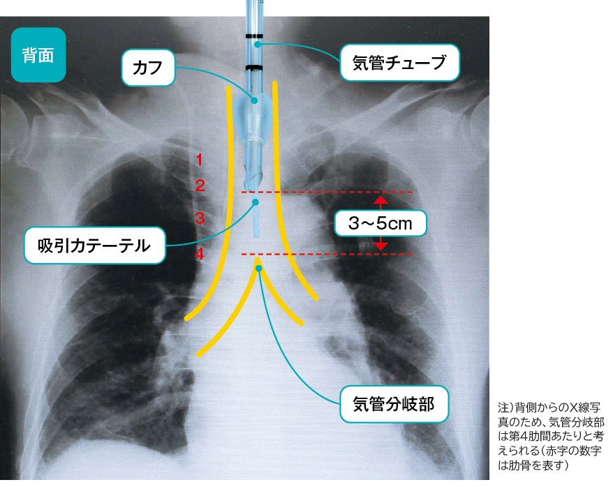 気管チューブの位置と吸引カテーテル挿入の長さ