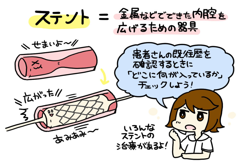 ステントイラスト2