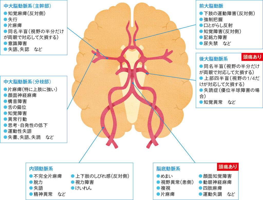 脳 梗塞 症状