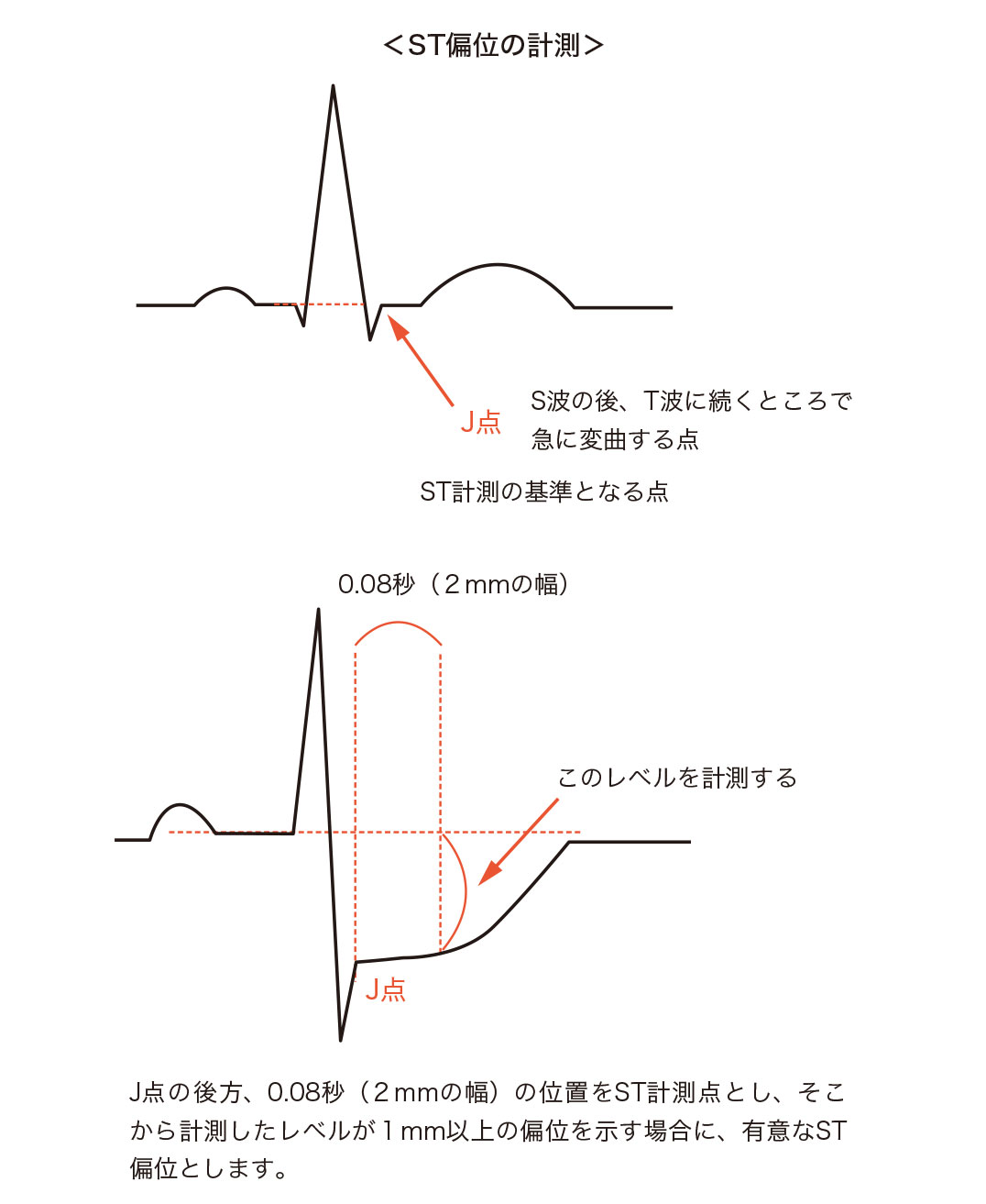 ST偏位の計測
