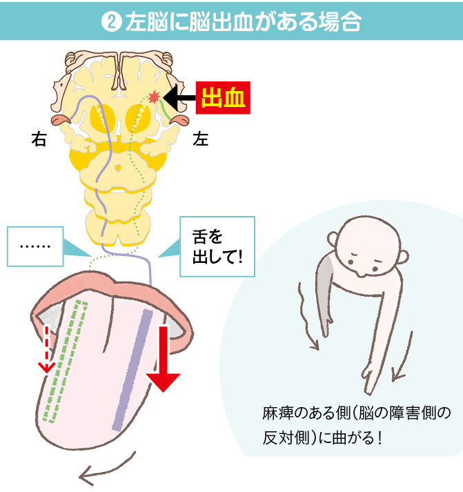 舌の麻痺のイメージ２