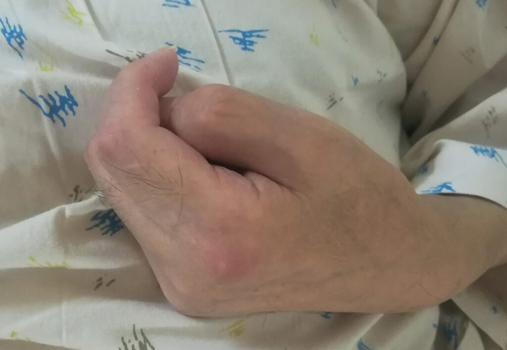 手足に拘縮のある患者さん