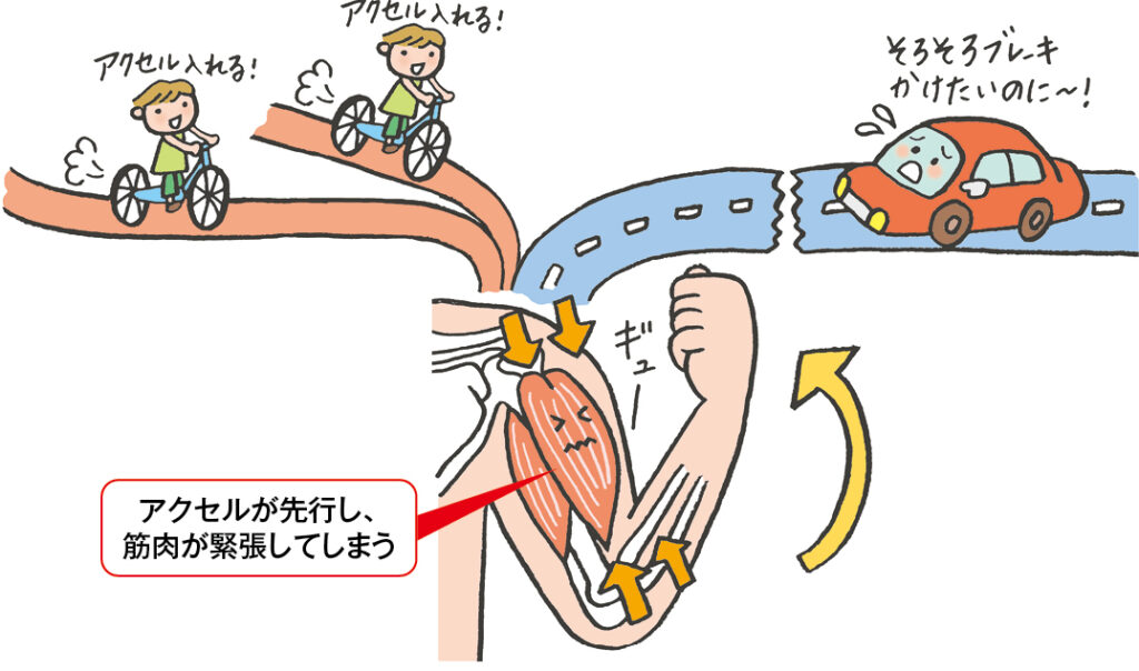 麻痺が拘縮につながるしくみ