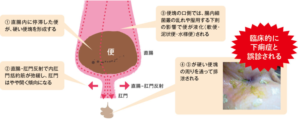 糞便塞栓の症状・検査・治療は？図とともに解説 | エキスパートナースweb