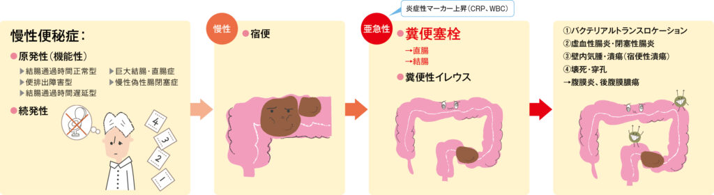 宿便から糞便塞栓への進展の図